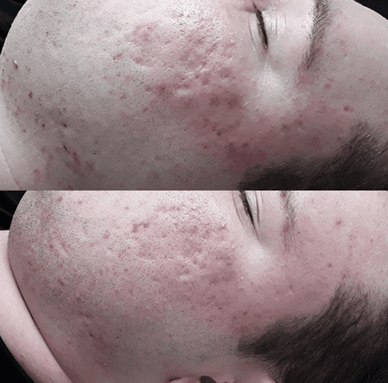acne scar rejuvenation before and after