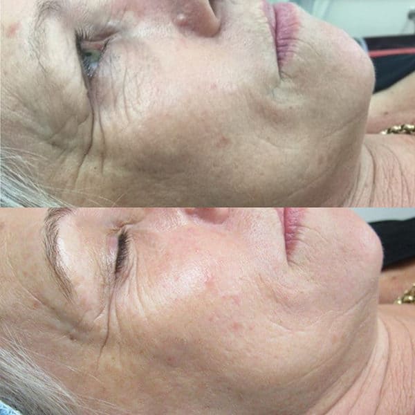 results after a combination of peels & skin needling – 4-6 treatments of both