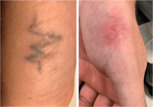 Surgical Tattoo Removal Surgical Tattoo Removal